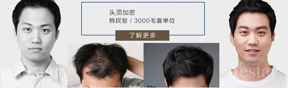 小雅美眼案例