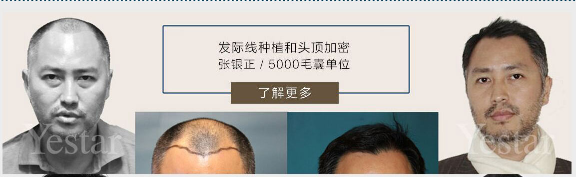 Yestar眼部整形案例
