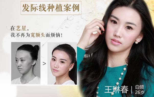 Daisy发际线案例