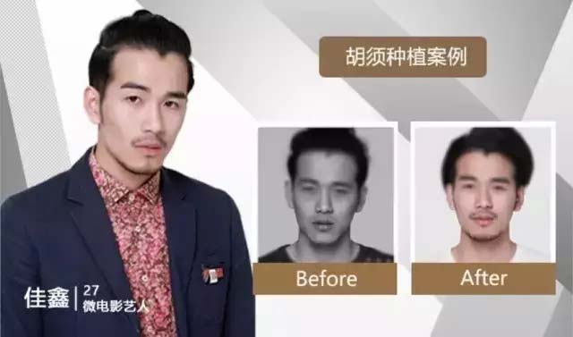 李恩胡须种植案例